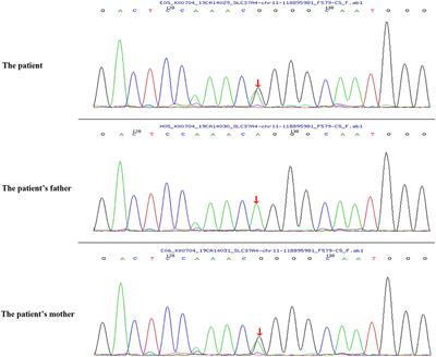 A Novel Lipoprotein Lipase Mutation in an Infant With Glycogen Storage Disease Type-Ib and Severe Hypertriglyceridemia